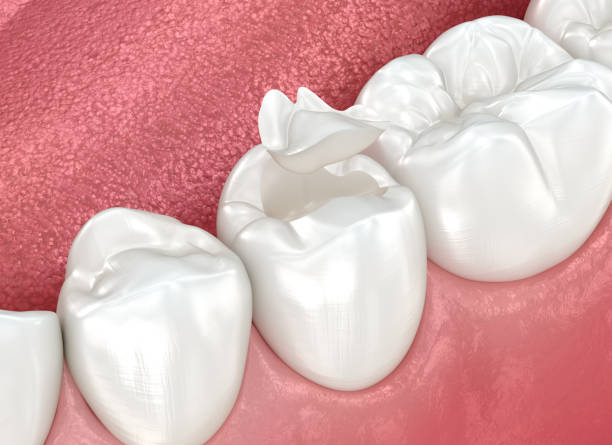 Best Dental Inlays and Onlays  in Bertville, AL